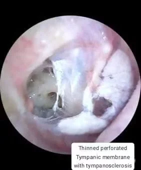 Hearing loss assessment — otoscopy by Prof. Dr. Muhammad Irshad Malik