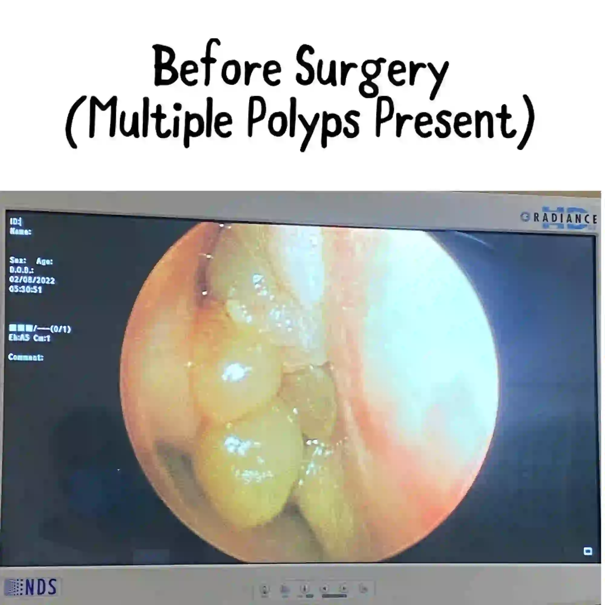 Nasal obstruction assessed by Prof. Dr. Muhammad Irshad Malik