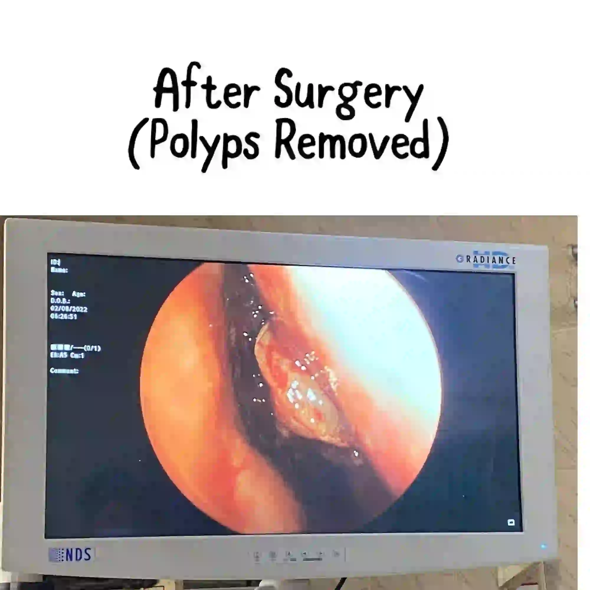 FESS / endoscopic sinus surgery by Prof. Dr. Muhammad Irshad Malik