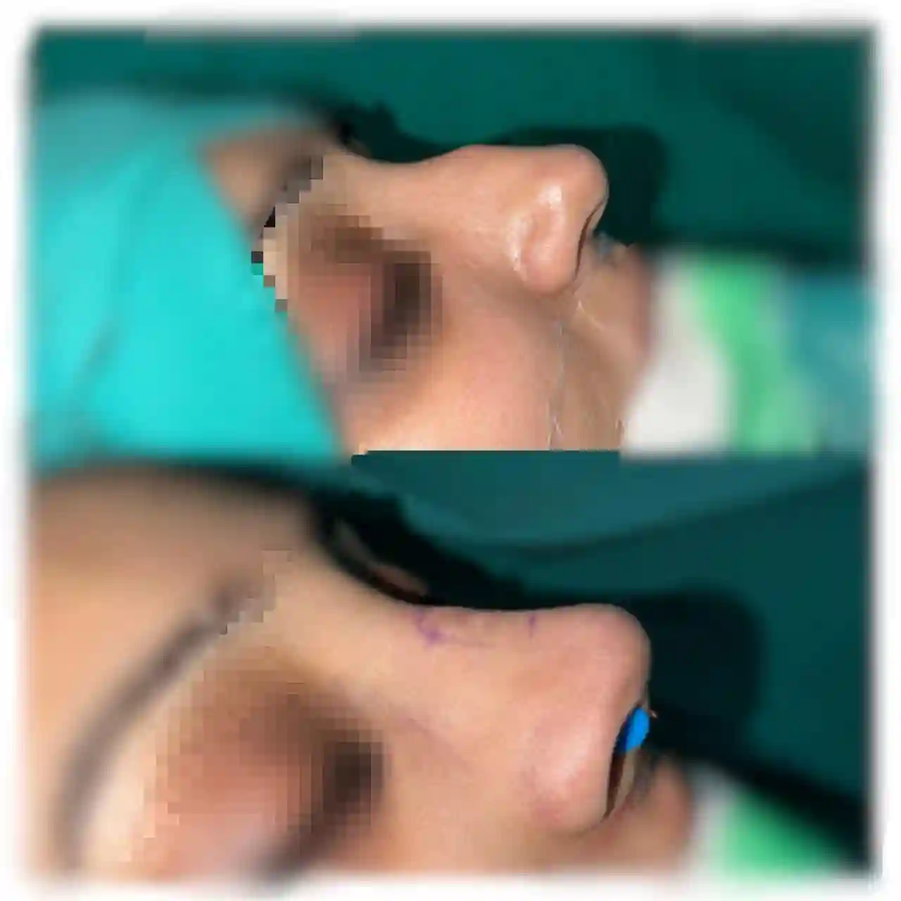 Rhinoplasty by Prof. Dr. Muhammad Irshad Malik
