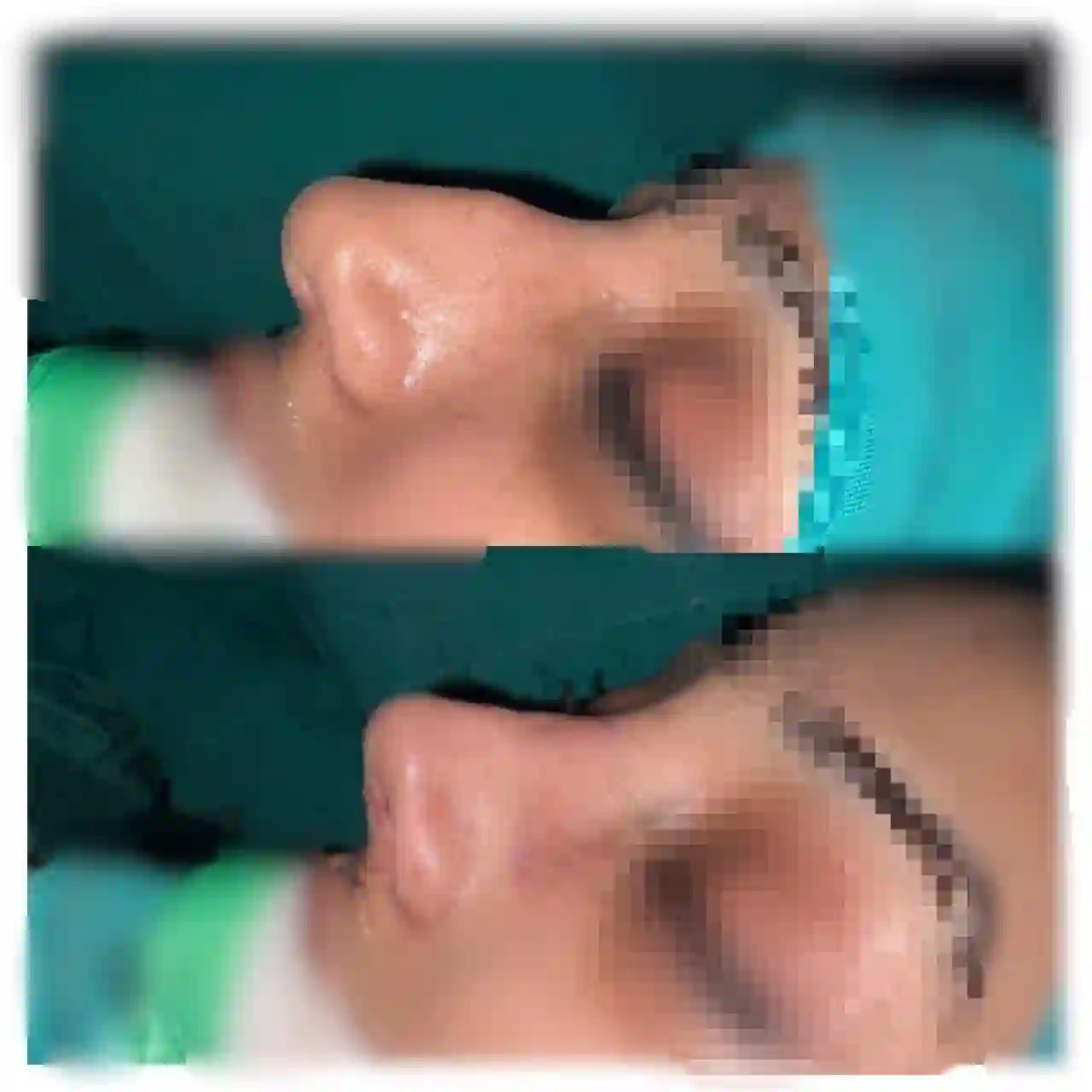 Septoplasty by Prof. Dr. Muhammad Irshad Malik