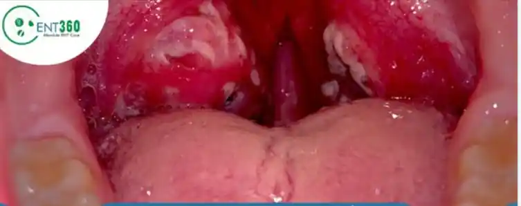 Tonsillitis assessed by Prof. Dr. Muhammad Irshad Malik