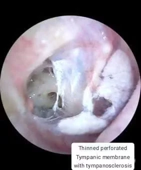 Ear and hearing care by Prof. Dr. Muhammad Irshad Malik