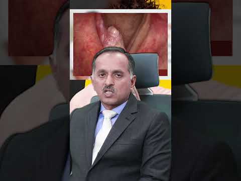 Throat infections that cause voice changes and vocal cord warning signs